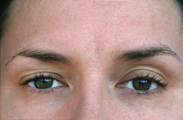 Botox for a More Natural-Looking and Youthful Eyes